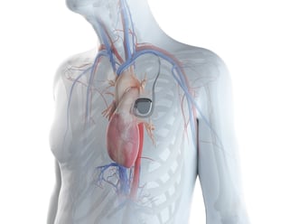 EMI Filter Assemblies for Implantable Defibrillators